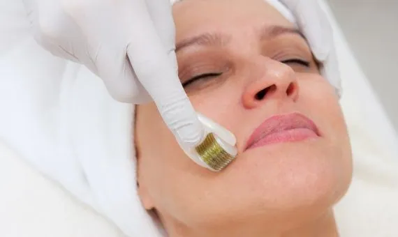 Microneedling Behandlung